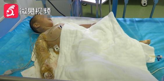 医生回应烧伤妈妈“钢丝球清创”,医生回应烧伤妈妈钢丝球清创，深度解析治疗过程与医患互动的重要性