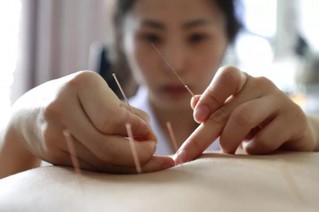 针灸滴滴，一针情暖，友情汇聚的力量