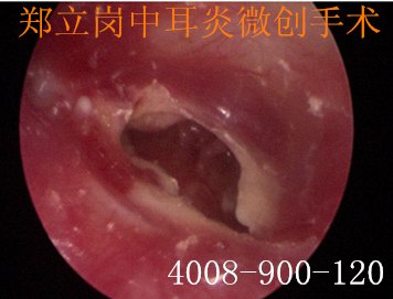 揭秘最新胆脂瘤手术价格，全方位解读手术费用及注意事项