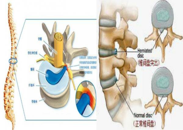 脊突发炎：脊突炎怎么保守治疗 
