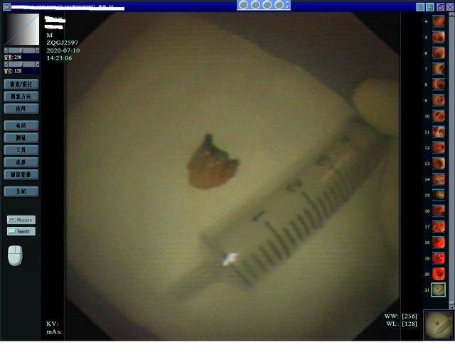 拔牙之后咳嗽不断：拔完牙咳嗽会不会影响伤口 