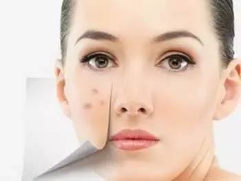 突发脸部出油长痘，成因解析与应对妙招