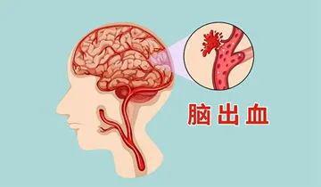 颅内出血,了解、应对与关怀之道