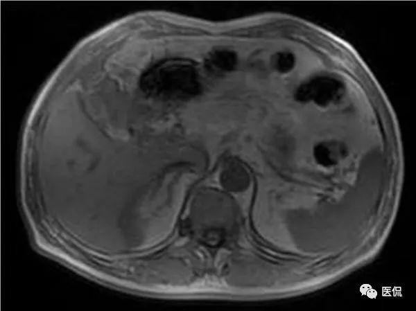 突发右中腹部隐痛，原因、诊断及治疗方法全解析