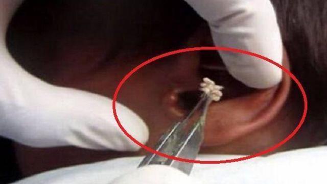 大人半夜突发耳朵疼痛:夜里突然耳朵疼