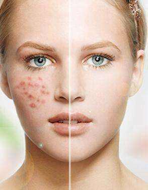 脸上不断长癣：脸上长癣一直不好怎么办 