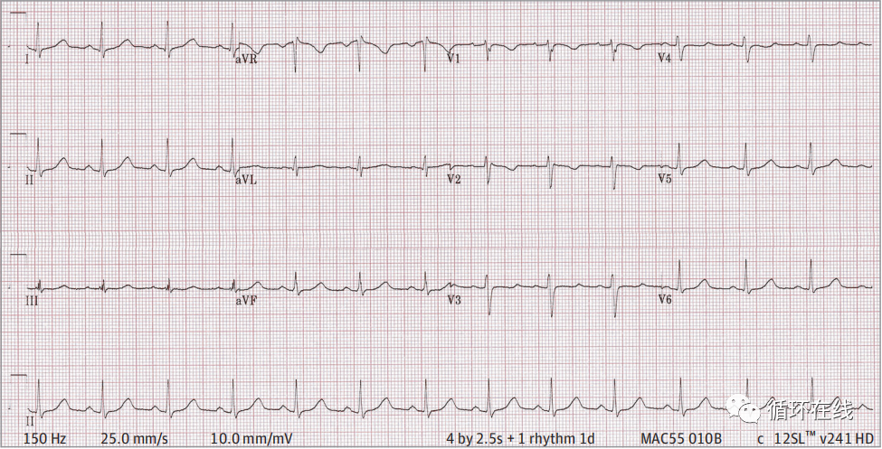 突发胸痛背后的心电图之谜，解析复杂情况下的健康危机