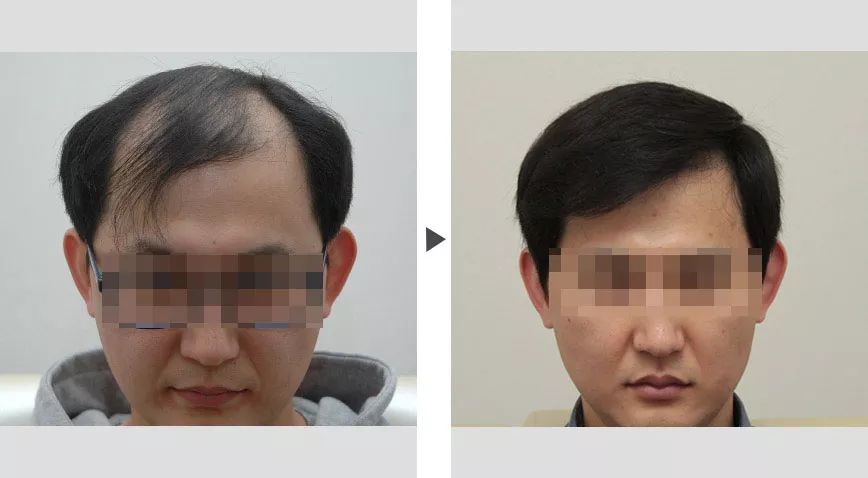 眼屎频繁困扰？解决方法大揭秘！