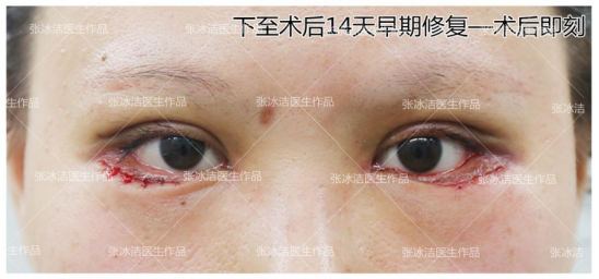 突发睑结膜出血，症状解析及应对之策