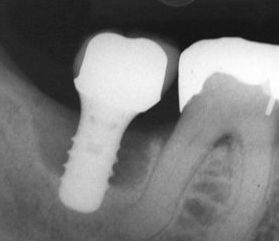 咽鼓管口粘连治疗最新研究成果揭秘