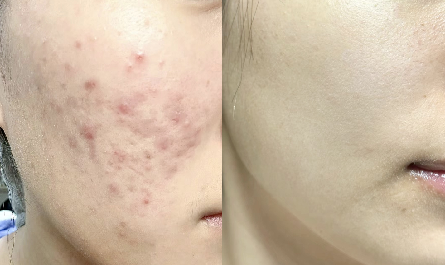 揭秘脸部粉刺频发原因，如何有效应对粉刺困扰？