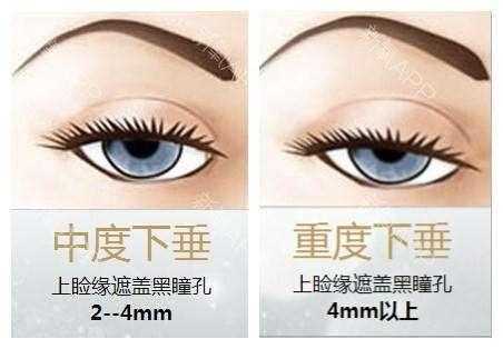 突发性单眼上睑下垂,全面解析原因、诊断与治疗