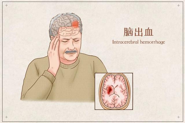 突发老年痴呆的原因深度解析，警惕这些潜在风险！